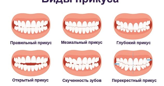 Что представляет собой прикус и почему его корректировка необходима?