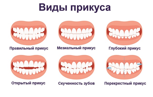 Что представляет собой прикус и почему его корректировка необходима?